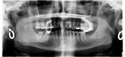 dental x-ray dental x-ray