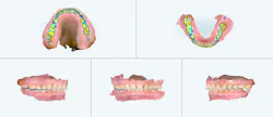 intraoral scans of teeth intraoral scans of teeth