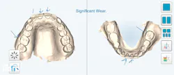 intraoral scans of teeth intraoral scans of teeth