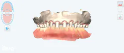 digital stone model of teeth digital stone model of teeth