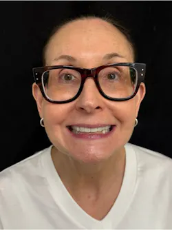 full-face photo of a dental patient with temporary tooth restorations full-face photo of a dental patient with temporary tooth restorations