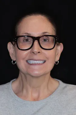 full-face photo of a dental patient with a big smile full-face photo of a dental patient with a big smile