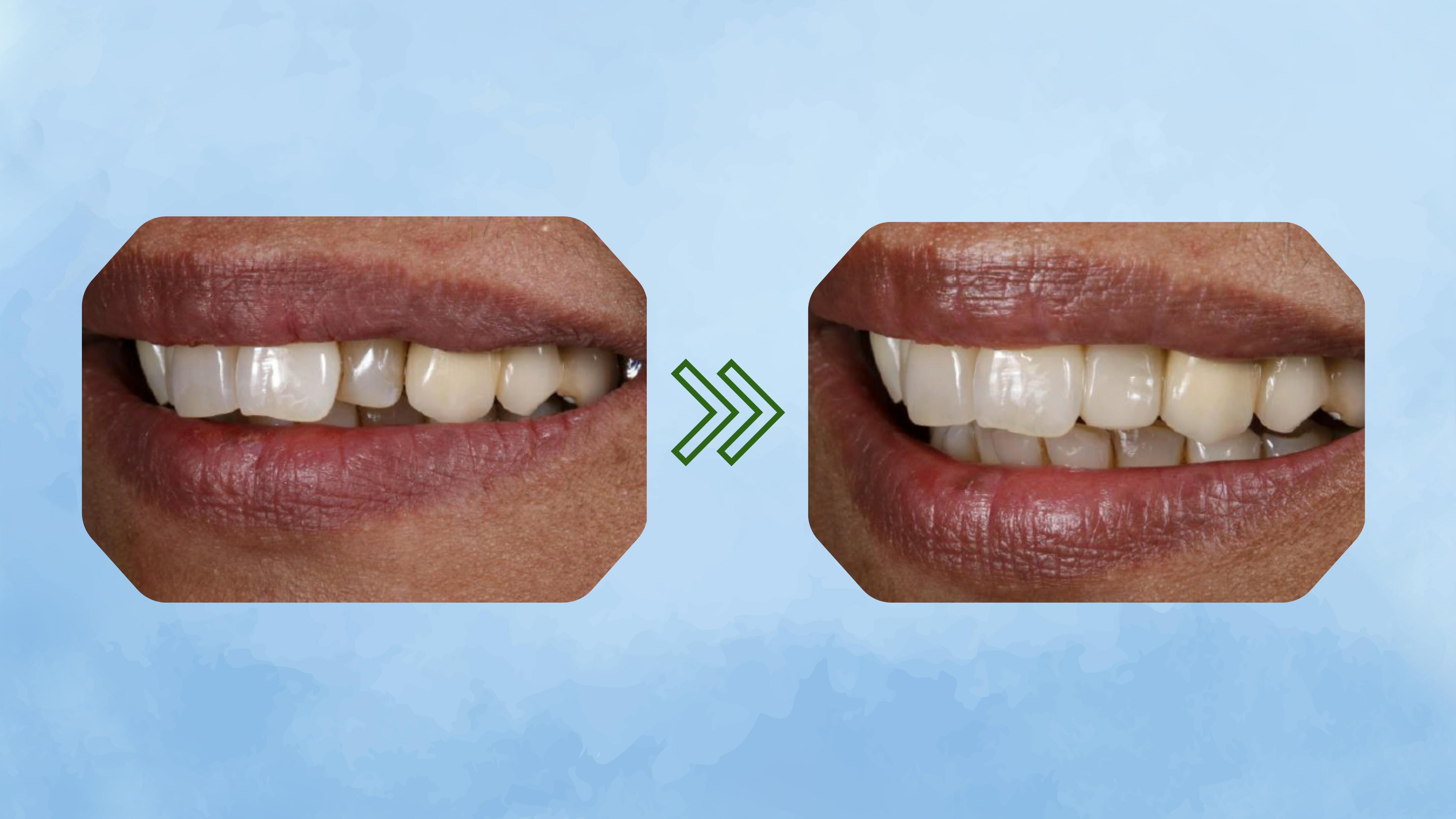 Before and after photo of teeth after veneer work