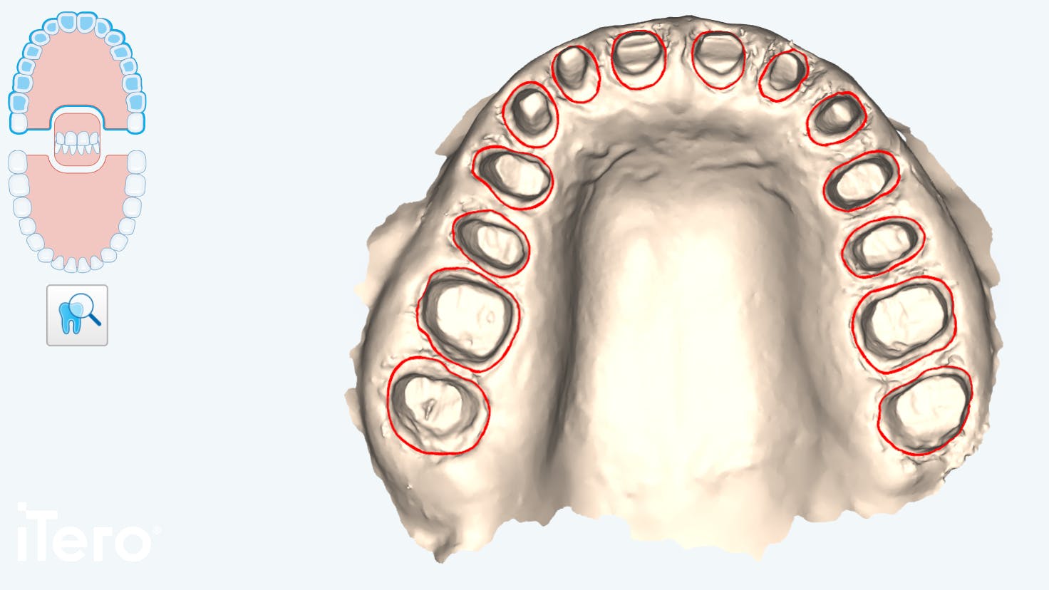 stone model of teeth