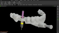 dental surgical guide design dental surgical guide design