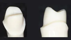 dental crown preps dental crown preps