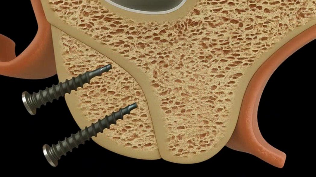 illustration of a dental implant procedure