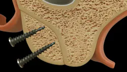 illustration of a dental implant procedure illustration of a dental implant procedure