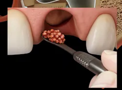 illustration of a dental grafting procedure illustration of a dental grafting procedure