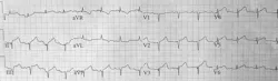 Electrocardiogram Fo Electrocardiogram Fo