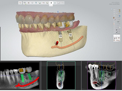 Content Dam Diq Online Articles 2015 02 Implant Softwarethumbnail