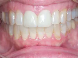 13decbfssegal06 13decbfssegal06