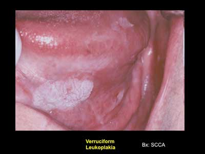 14aprfroumoralcancer01