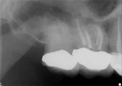 14jul15endolandwehrpostop1 14jul15endolandwehrpostop1