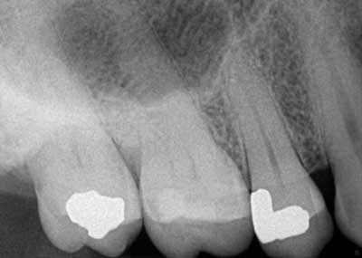 14jul15endosimmonscantsave01