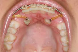 14jul17orthosimmons08 14jul17orthosimmons08