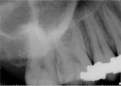 14may20endolandwehrreferredpainposteriorrt 14may20endolandwehrreferredpainposteriorrt