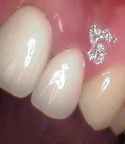 14sept16endosimmons Resorption02 14sept16endosimmons Resorption02