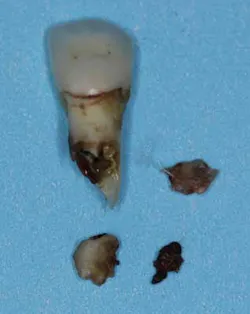 14sept16endosimmons Resorption04 14sept16endosimmons Resorption04