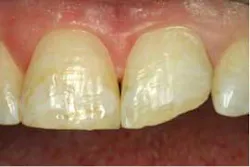 2014blank3mscotchbondtotaletch02 2014blank3mscotchbondtotaletch02