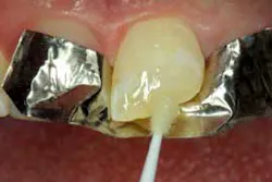 2014blank3mscotchbondtotaletch04 2014blank3mscotchbondtotaletch04