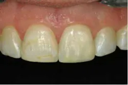 2014blank3mscotchbondtotaletch06 2014blank3mscotchbondtotaletch06