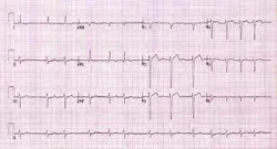 Atrial Fibrillation Fo Atrial Fibrillation Fo