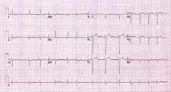 Atrial Fibrillation Fo Atrial Fibrillation Fo