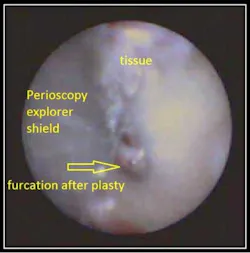 Clean Furcation Fo Clean Furcation Fo