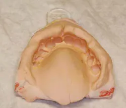 Dental Impressions Dental Impressions