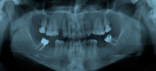 Dental X Ray