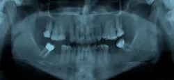 Dental X Ray Dental X Ray