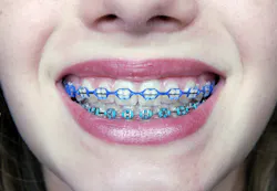 Dreamstimebraces Dreamstimebraces