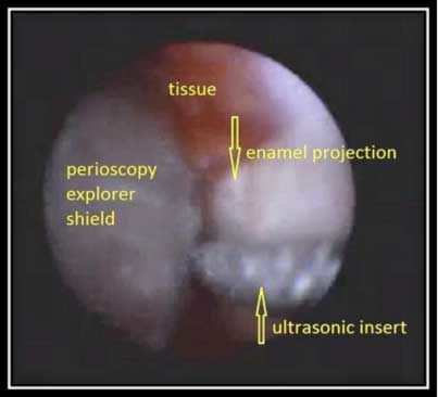 Enamel Projection Fo