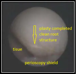 Enamoplasty Fo Enamoplasty Fo