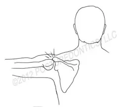 Impingement Fo Impingement Fo