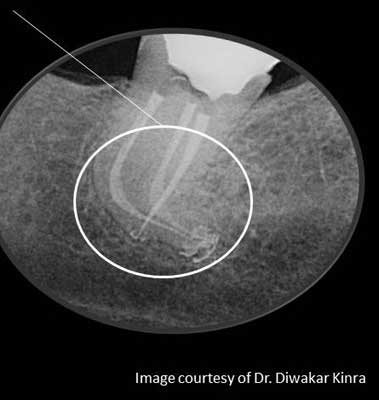 Kinra Curve Obturation Endo