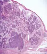 Oropharyngeal Fo Oropharyngeal Fo