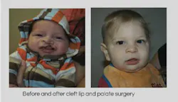 Quintencleftpalatesurgery Quintencleftpalatesurgery