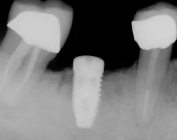 Sawyer Xray 1 Sawyer Xray 1