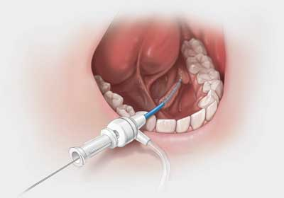 Sialendoscopy
