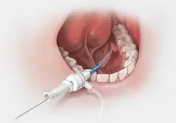 Sialendoscopy Sialendoscopy