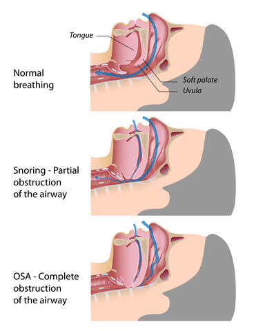 Sleep Apnea Dreamstime For Web