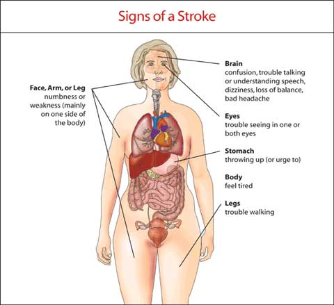 Stroke Signs Fo