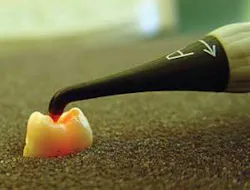 Th 0506dem Caries02 Th 0506dem Caries02