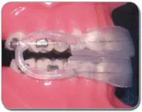 Th Masel Bite Appliance Th Masel Bite Appliance