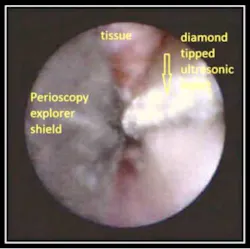 Ultrasonic Insert Fo Ultrasonic Insert Fo