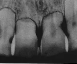 Figure 1: Root resorption Figure 1: Root resorption