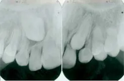 Figure 2: Severe root resorption evident on maxillary lateral incisors Figure 2: Severe root resorption evident on maxillary lateral incisors