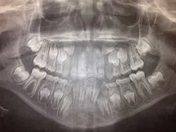 Figure 4a: Fixed lingual retainers placed from lateral incisor to lateral incisor Figure 4a: Fixed lingual retainers placed from lateral incisor to lateral incisor
